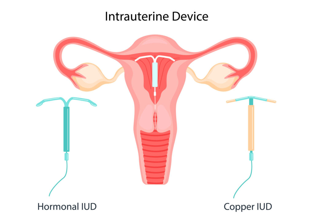 The method of IUD-contraception. Control and protection of pregnancy. Intrauterine device in the uterus. vector illustration in a flat style.