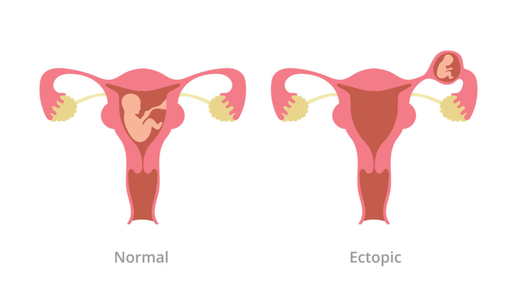 ectopic pregnancy pregnancy problem with comparison with normal pregnancy with modern flat style vector illustration